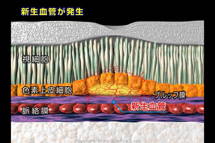 図２、脈絡膜新生血管の発生