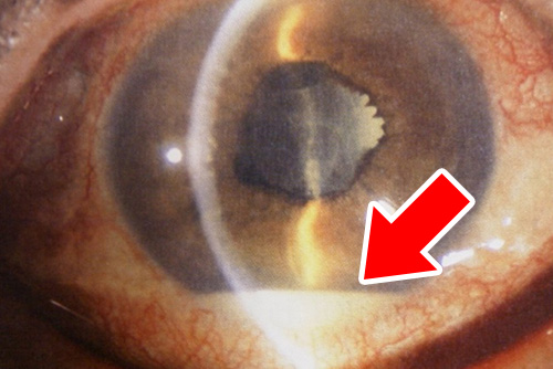 術後眼内炎：眼の中に“膿“（矢印の白い部分）がたまっています。