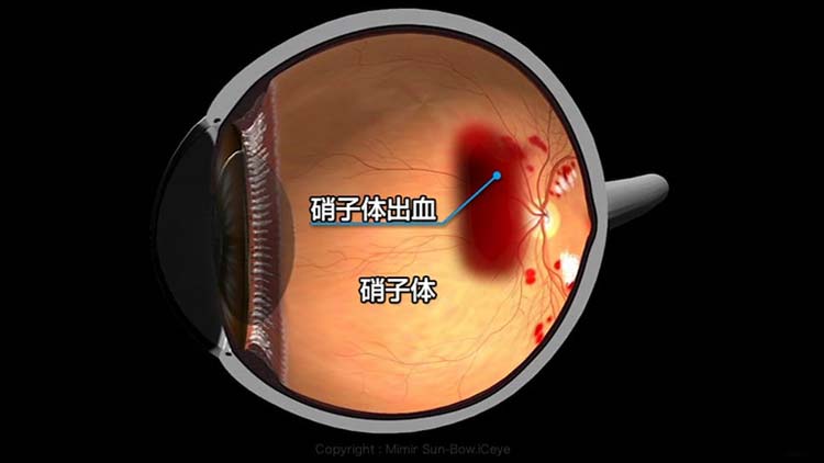 硝子体出血：眼の中に出血が起きると視力が急に低下する