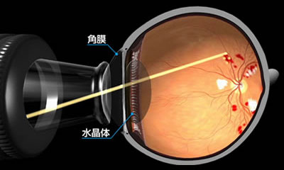 網膜光凝固術：レーザーで網膜を凝固して悪化を食い止める