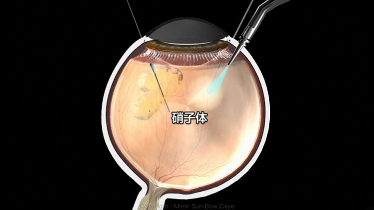 硝子体手術：器具を直接眼球内に入れて硝子体を切除する。