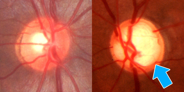 図６　右：正常な視神経乳頭　　左：視神経乳頭陥凹拡大（矢印：神経細胞が萎縮した視神経乳頭）
