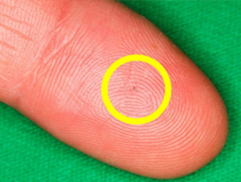 図７、この指の先に写っている黒い粒がアイステント。