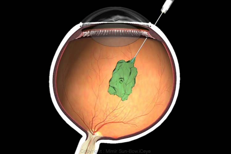 図３、直接　抗VEGFを眼球に注射します。